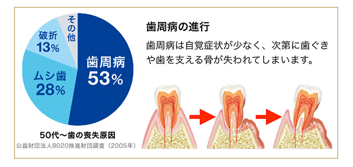 歯を失う原因で一番多い歯周病