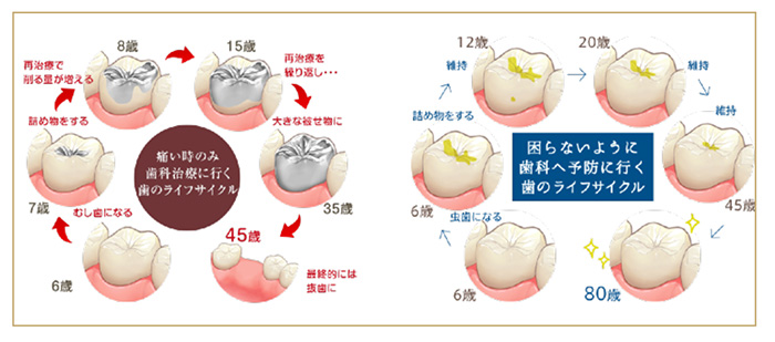 むし歯を繰り返すリスクを軽減する治療法