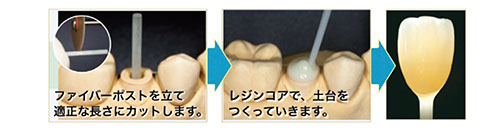 特殊構造で歯を守るセラミック治療