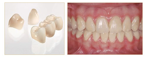 歯周病から歯を守るセラミック治療