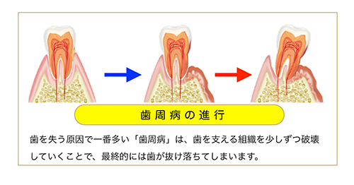 ムシ歯菌と歯周病菌のバランス