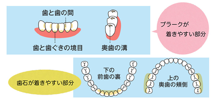 口腔健康を守る細菌コントロール