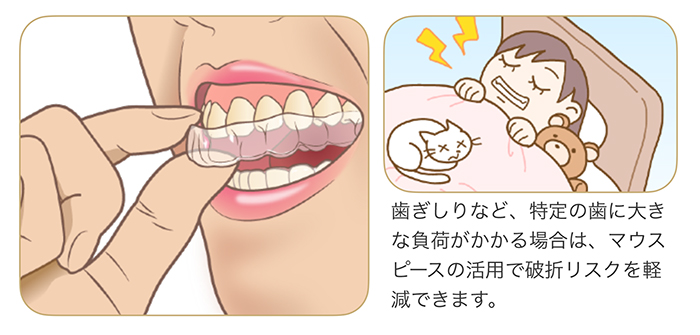 治療ができず抜歯になる歯根破折②
