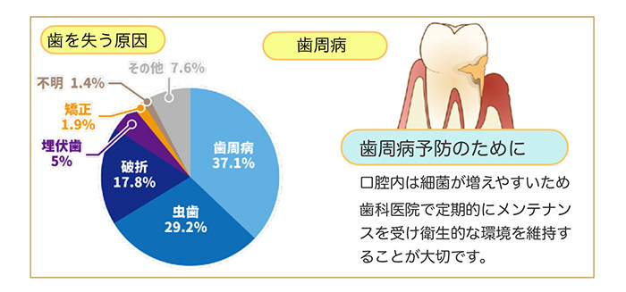 歯を失う原因の第1位歯周病
